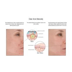 LightStim For Acne -Beauty Personal Care clear acne 1